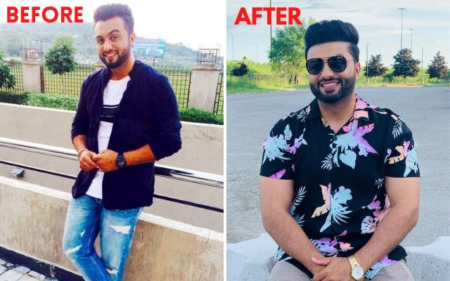 These Punjabi Celebrities Underwent Hair Transplant!